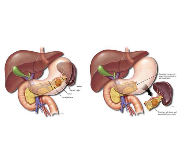 Distal-Pancreatectomy-And-Splenectomy