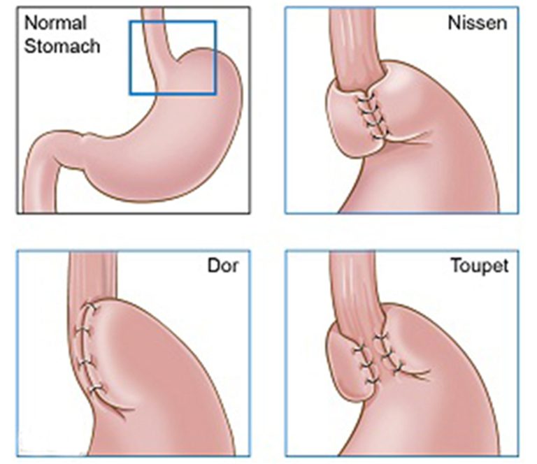 Best Weight Loss Surgery In Mumbai