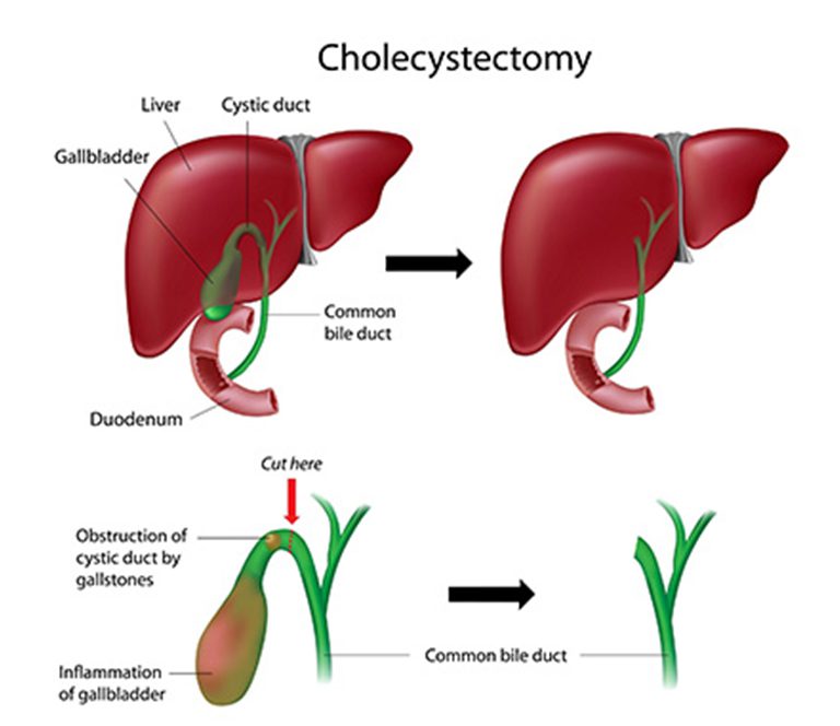 Bariatric Surgeon In Mumbai