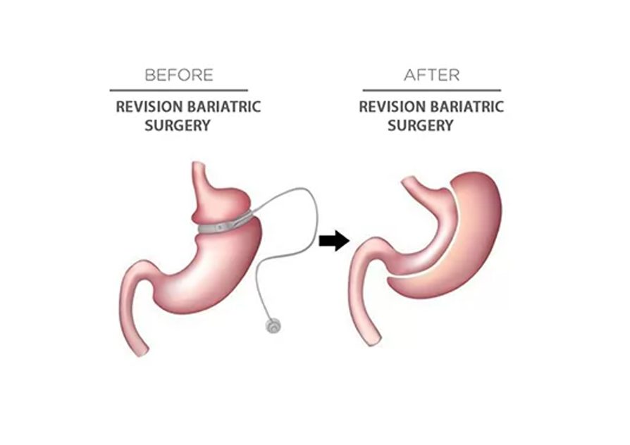 Obesity Surgery Hospital In Mumbai