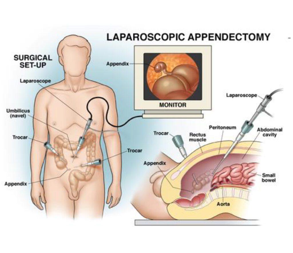 Laparoscopy Hospital In Mumbai