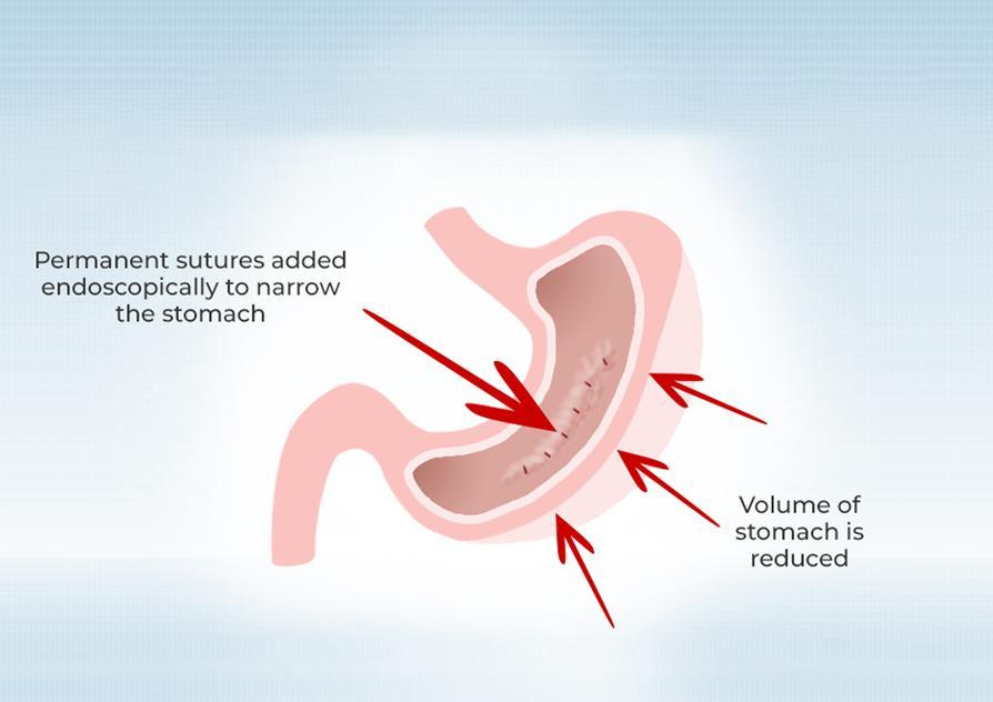 Hernia Specialist Doctor In Mumbai