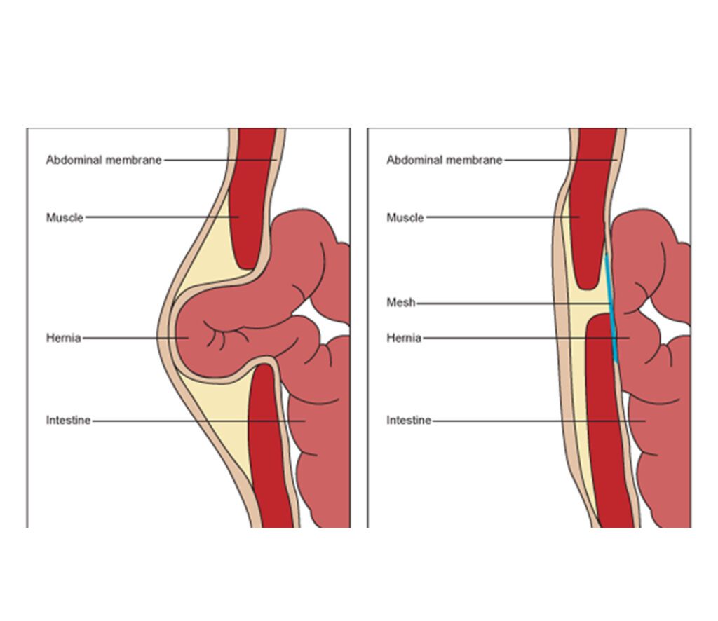 Sleeve Surgery Doctor In Mumbai