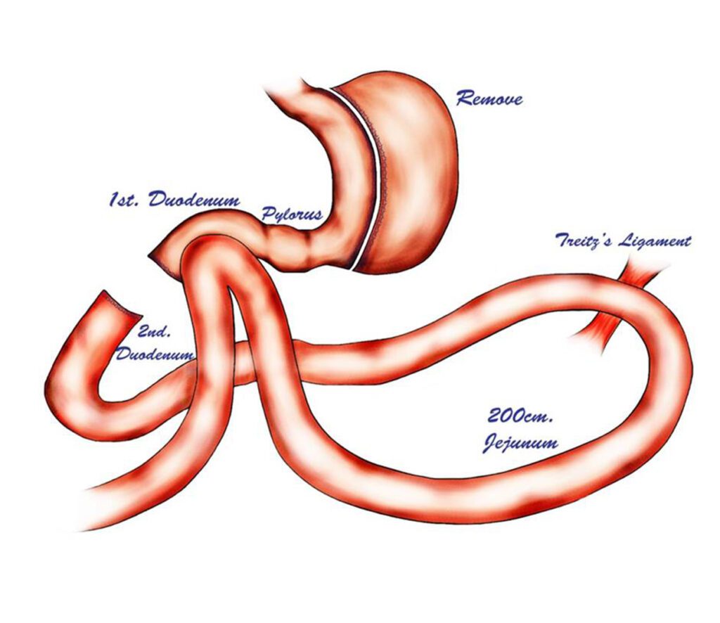 Anti Reflux Surgery In Mumbai