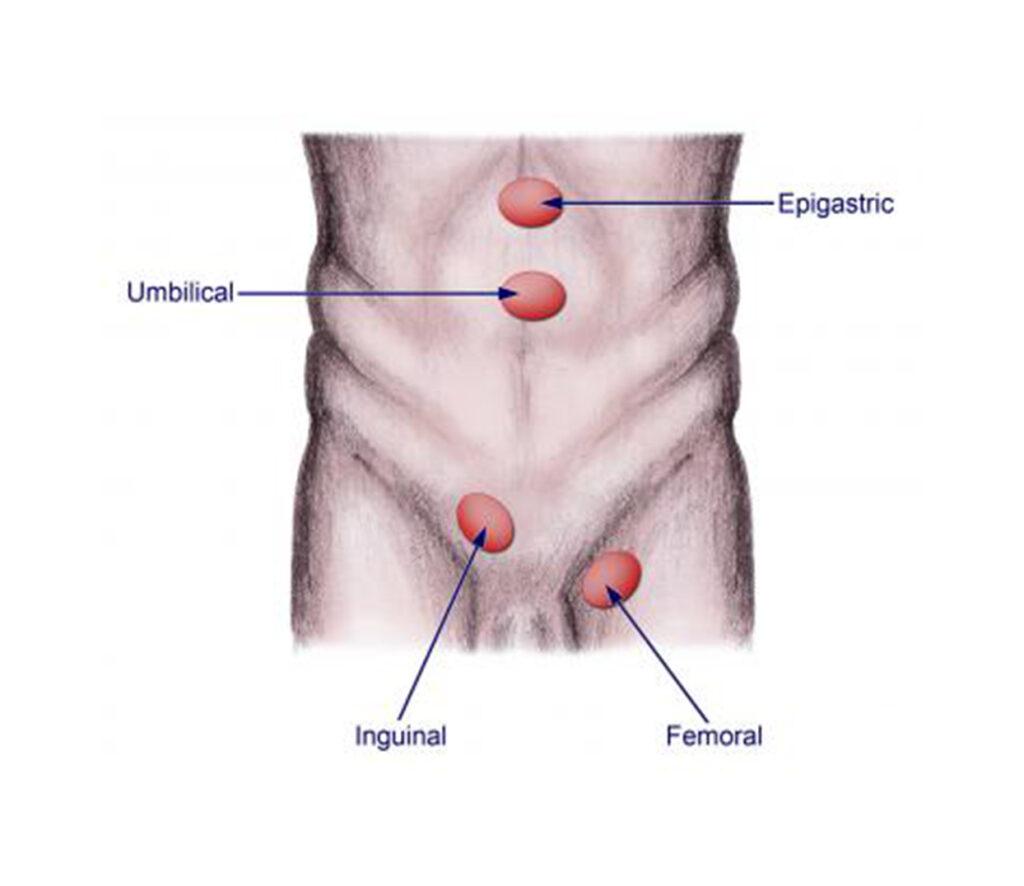 Best Doctor For Hernia In Mumbai