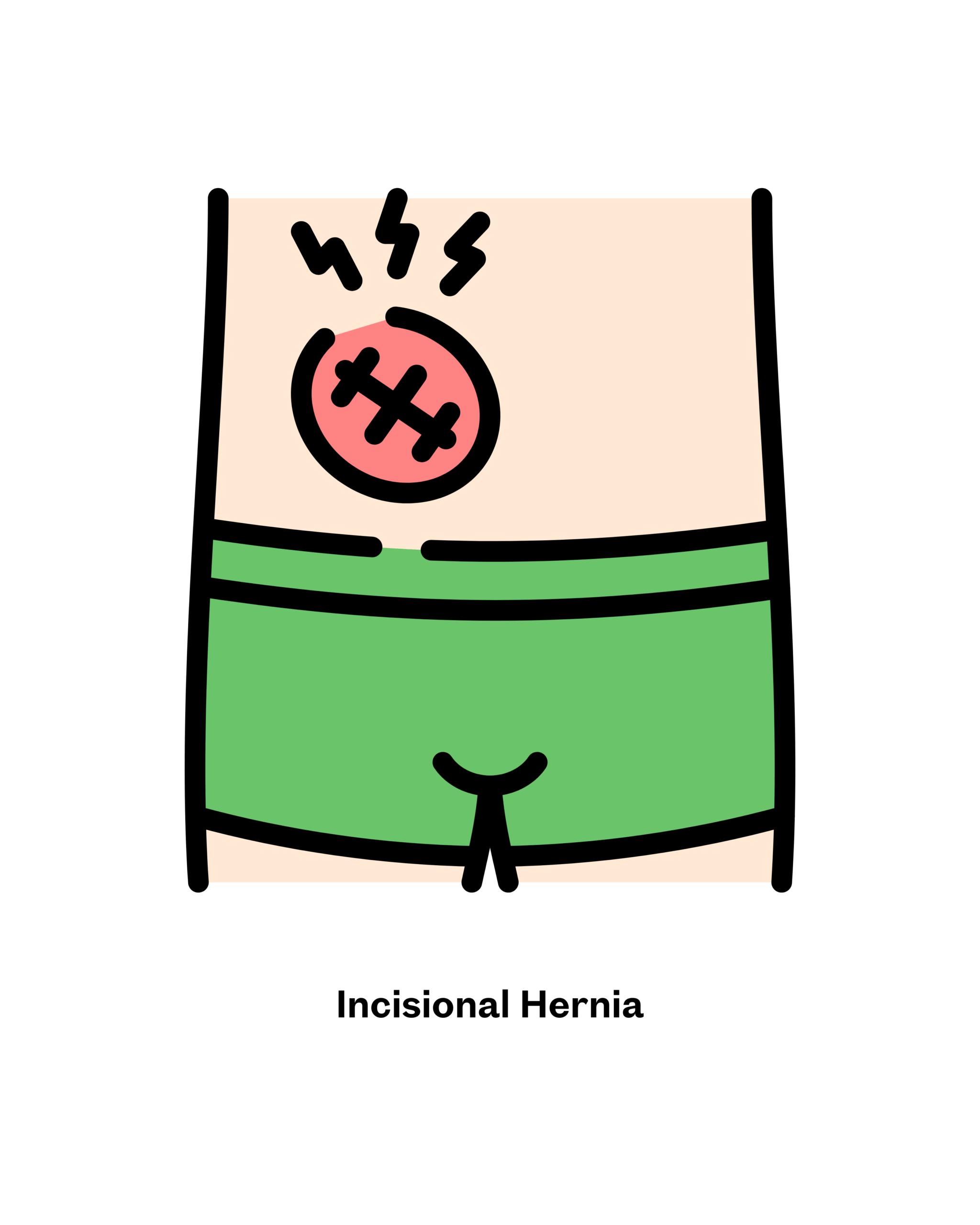 Groin Hernia Surgery in Mumbai |Dr. Nidhi Khandelwal